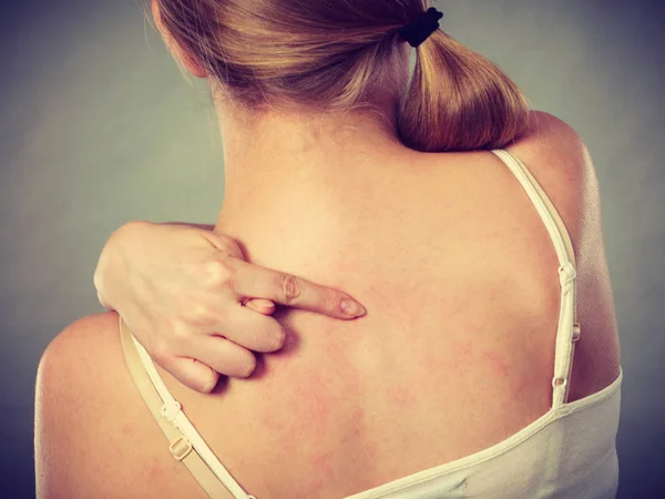 Mujer rascándose la espalda con picazón con erupción alérgica —  Fotos de Stock