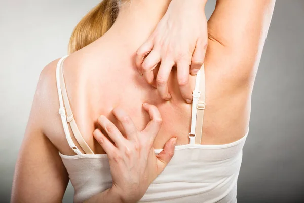 Женщина царапает спину зудом аллергической сыпью — стоковое фото