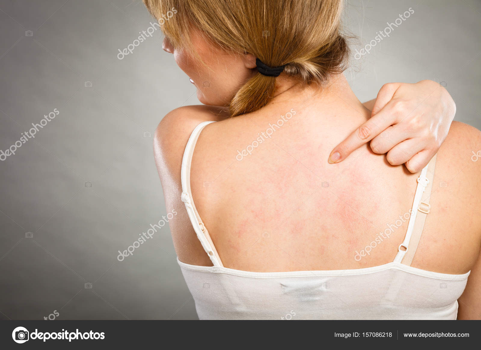 Woman scratching her itchy back with allergy rash Stock Photo by