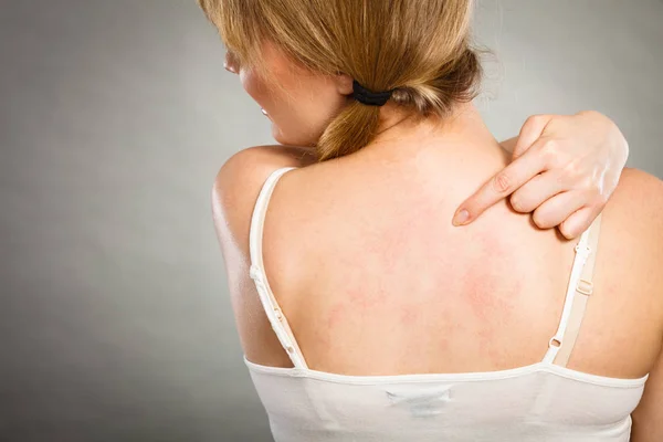 Vrouw haar jeukende terug met allergie huiduitslag krabben — Stockfoto