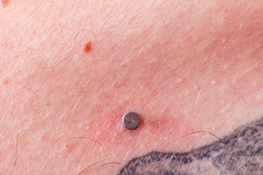 Göğüs kemiği, bölünme, microdermal, köprücük üzerinde piercing yüzey.