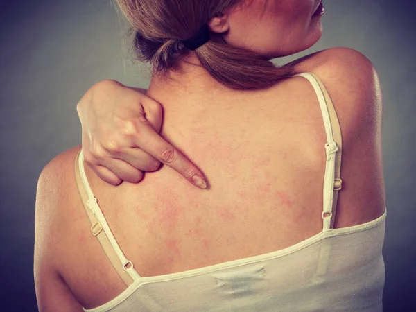 Vrouw haar jeukende terug met allergie huiduitslag krabben — Stockfoto