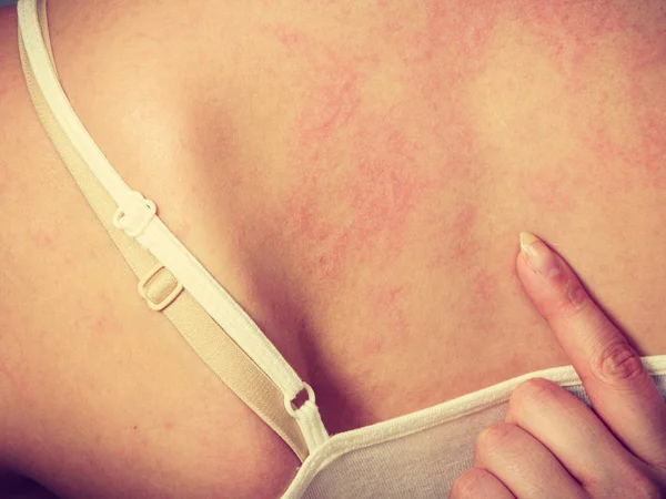 Жінка подряпає свербіж назад алергічним висипом — стокове фото