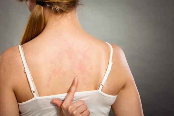 Vrouw haar jeukende terug met allergie huiduitslag krabben — Stockfoto