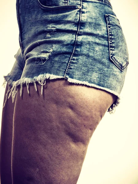 Pernas de mulher com pele de celulite — Fotografia de Stock