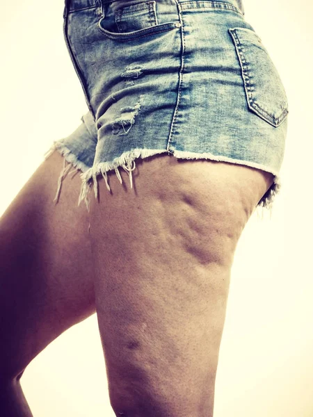 Jambes de femme avec peau de cellulite — Photo
