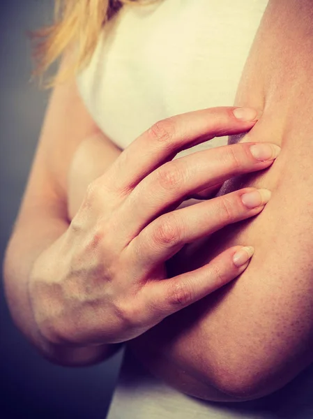 Vrouw haar jeukende arm met allergie huiduitslag krabben — Stockfoto