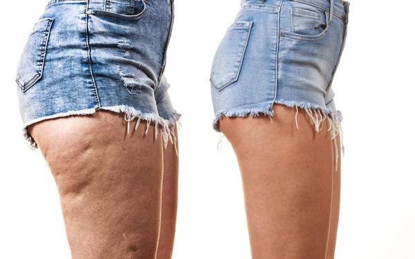 Сравнение ног с целлюлитом и без него — стоковое фото