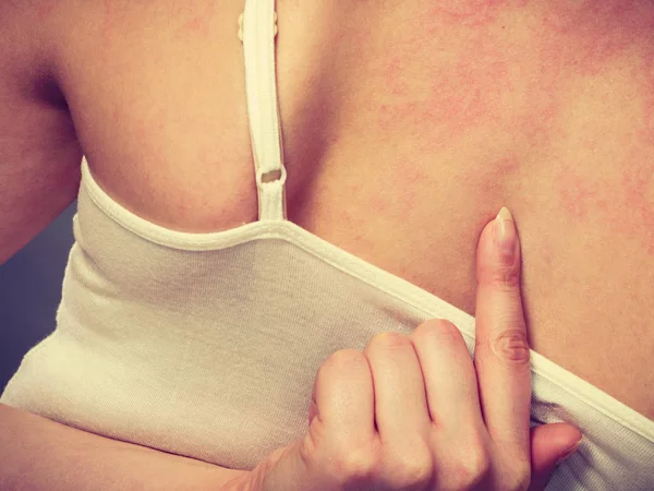 女人为她抓痒背与过敏皮疹 — 图库照片