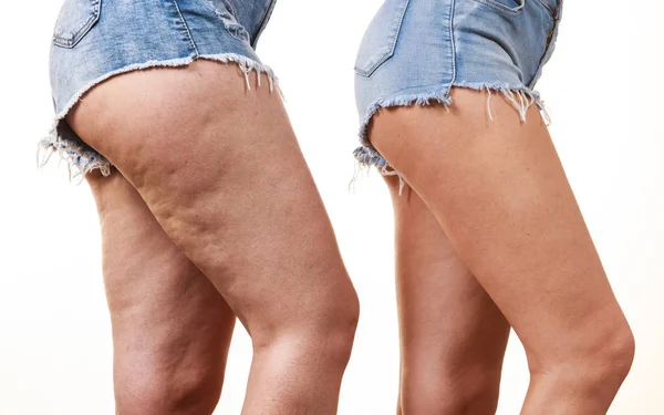 Vergelijking van de benen met en zonder cellulitis — Stockfoto