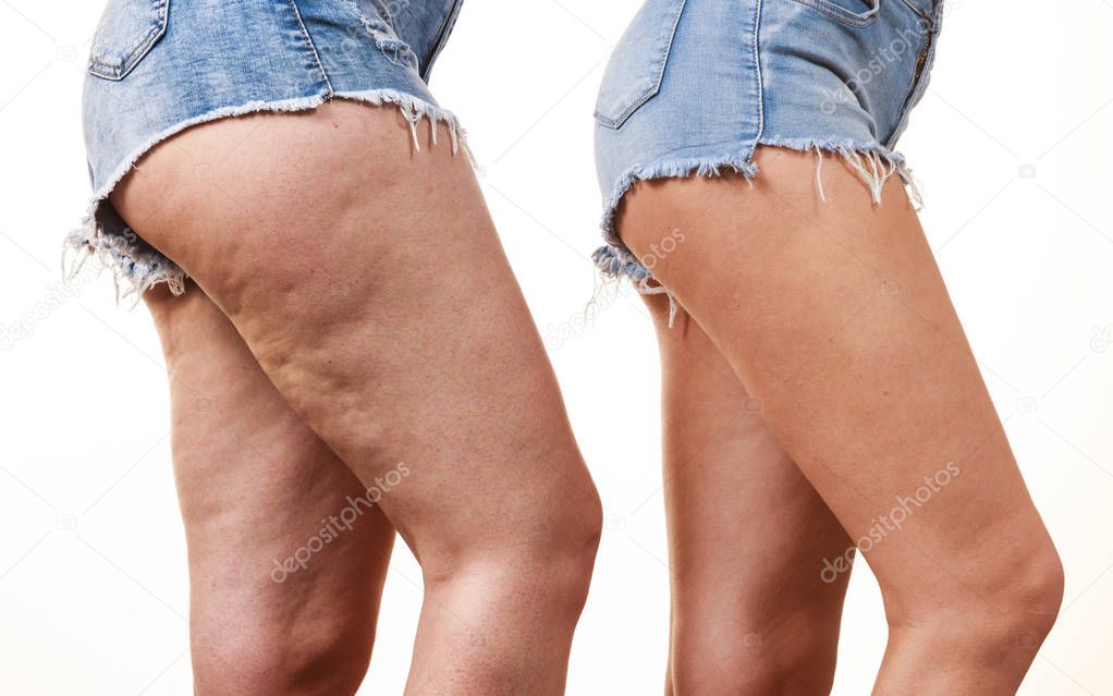 Comparison of legs with and without cellulite