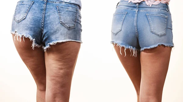 Vergleich von Beinen mit und ohne Cellulite — Stockfoto