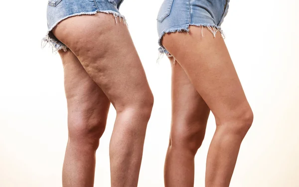 Сравнение ног с целлюлитом и без него — стоковое фото