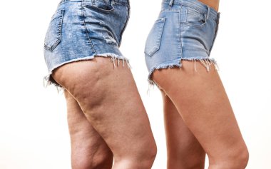 Bacaklar ve selülit olmadan karşılaştırılması