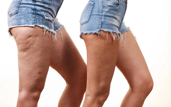 Jämförelse av ben med och utan celluliter — Stockfoto
