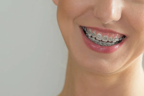 Fechar os dentes da mulher com aparelho — Fotografia de Stock