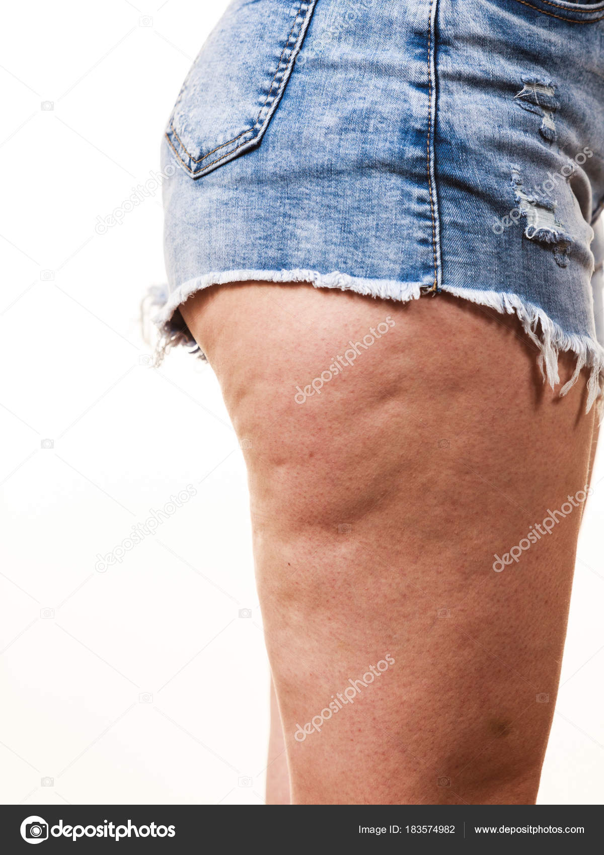 Cellulite thigh cheap