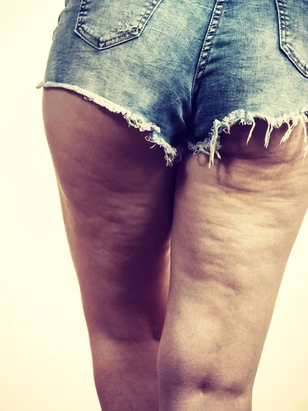 Женские ноги с целлюлитной кожей — стоковое фото