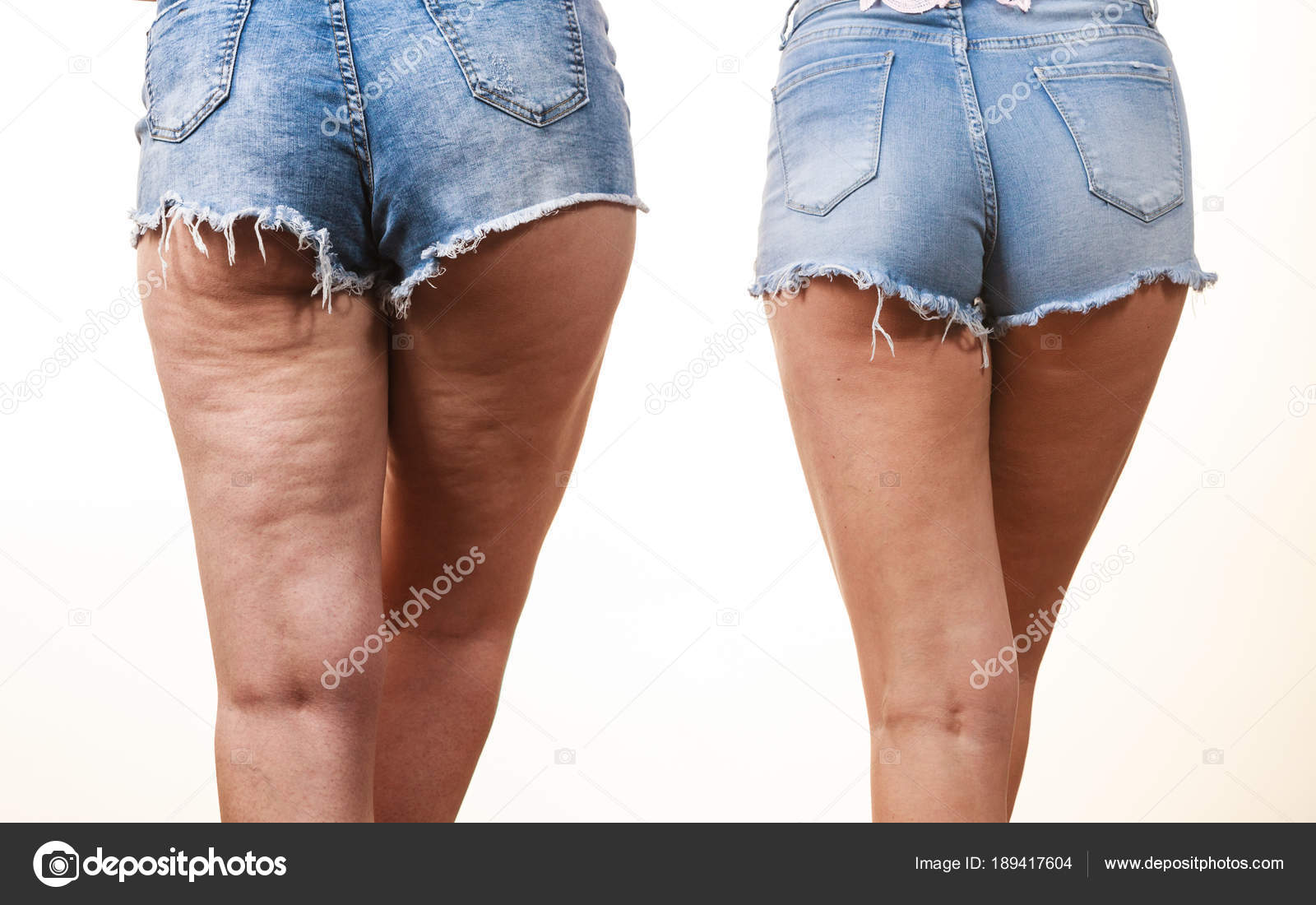 gambe con cellulite