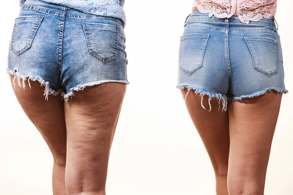 Comparison of legs with and without cellulite — Stock Photo, Image