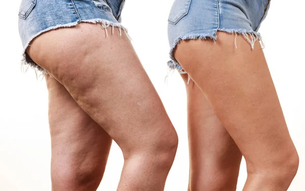 Confronto delle gambe con e senza cellulite — Foto Stock