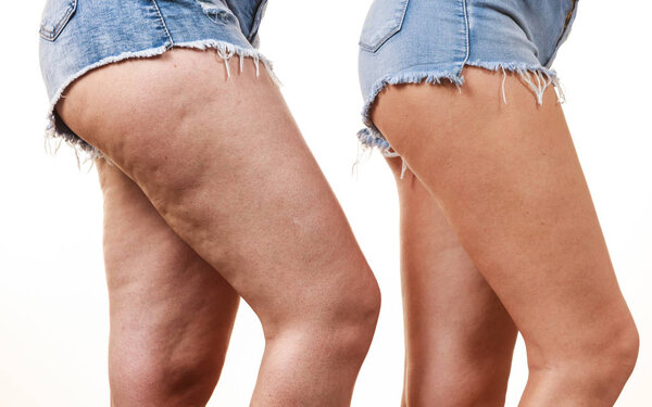 Comparison of legs with and without cellulite