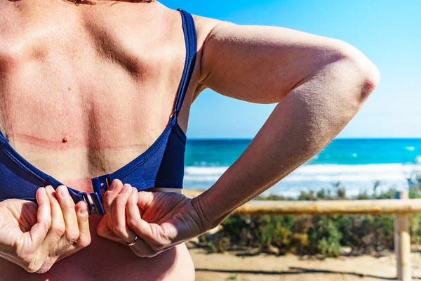 Femme dos peau blessée par les coups de soleil . — Photo