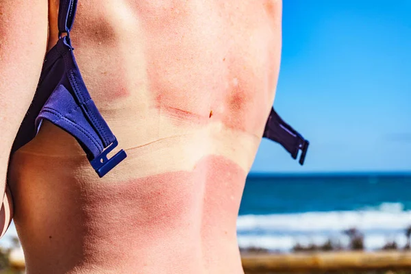 Woman back skin hurt from sun burn.