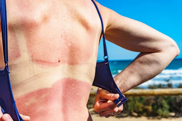 Woman back skin hurt from sun burn.