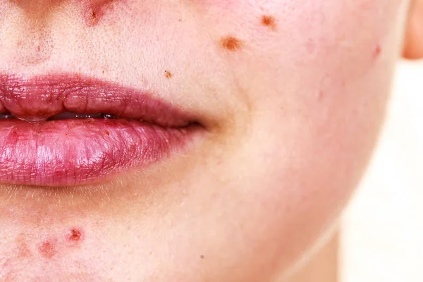 Rosto feminino com problema de pele acne — Fotografia de Stock