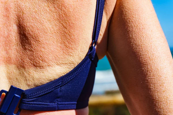 Woman back skin hurt from sun burn.
