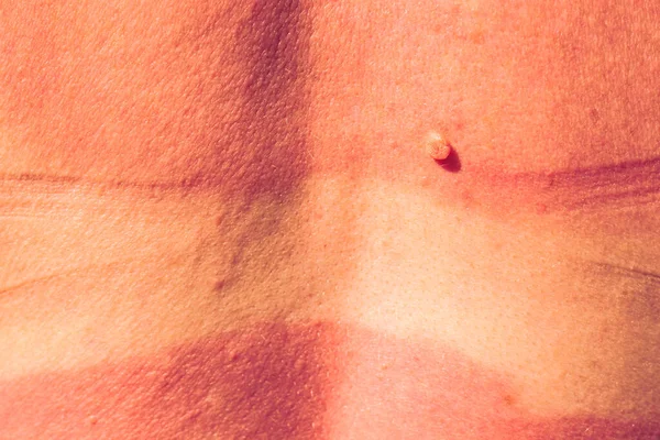 Caucasian woman back and shoulders skin hurt from sun burn. Severely burned skin, red tanned body