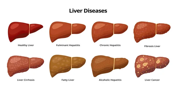 Friska lever- och leversjukdomar - fettlever, hepatit, fibros, cirros, alkoholhaltig hepatit, levercancer - medicinska infografiska element isolerade på vit bakgrund. — Stock vektor