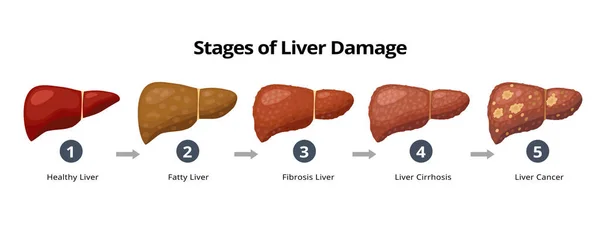 Stages of liver damage from healthy, fatty liver, fibrosis, cirrhosis to liver cancer. Medical infographic, liver diseases icons in flat design isolated on white background. — ストックベクタ