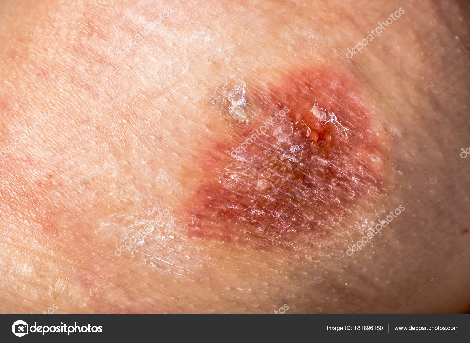 gros plan de lhomme de peau macro epidermis photo thinkstock gros plan d une br 251 lure chimique sur la peau avec une goutte de douloureux r 233 sidus de liquide et gros plan de lhomme de peau macro epidermis photo thinkstock gros plan d une br 251 lure chimique sur la peau avec une goutte de douloureux r 233 sidus de liquide et