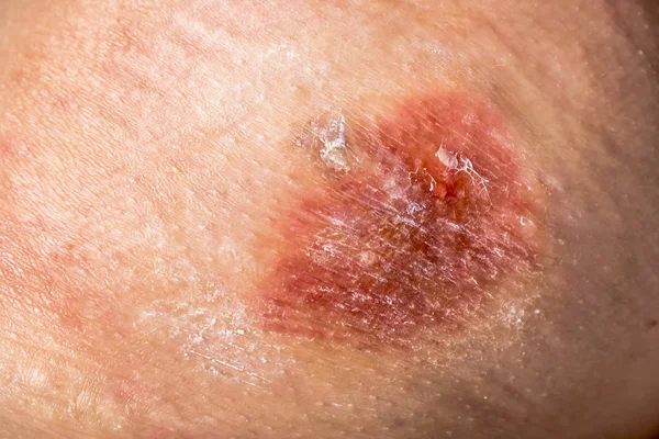 Close-up de queimadura química na pele com uma gota de líquido dolorido e resíduos de creme — Fotografia de Stock