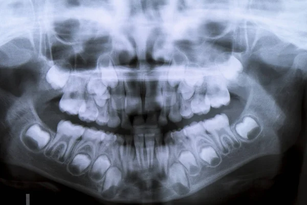 8 年間の彼の赤ちゃんの歯 - 永続的な赤ちゃんの歯を失うしないの問題児の歯科用 x 線パノラマ — ストック写真