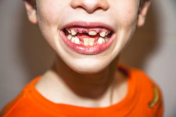 Primer plano del niño de ocho años con el problema de no perder sus dientes de leche (dientes de leche persistentes, también llamados enfermedad de los tiburones) después de la cirugía eliminación de los dientes de leche — Foto de Stock