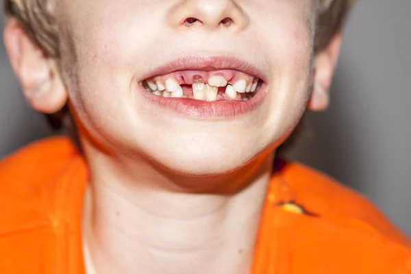 Крупним планом дитини вісім років з проблемою не вивільняти зуби дитини стійкі дитячі зуби, які також називаються хворобою акули після операції видалення молочних зубів — стокове фото
