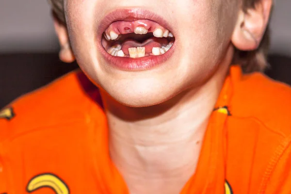 ミルクの歯の手術を削除した後彼の赤ちゃんの歯 - 永続的な乳歯、サメ病とも呼ばれます - を失うしないの問題で 8 歳の子供のクローズ アップ — ストック写真