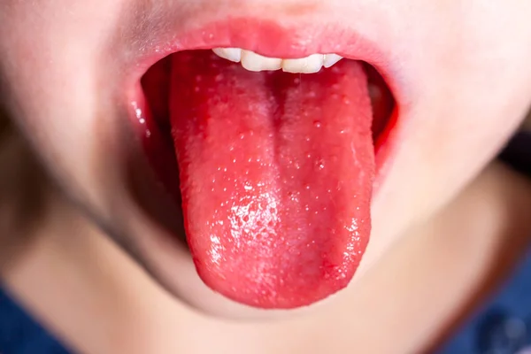 Lingua di un bambino con scarlattina - lingua di fragola — Foto Stock