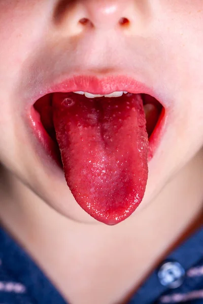 Tongue of a child with scarlet fever - strawberry tongue