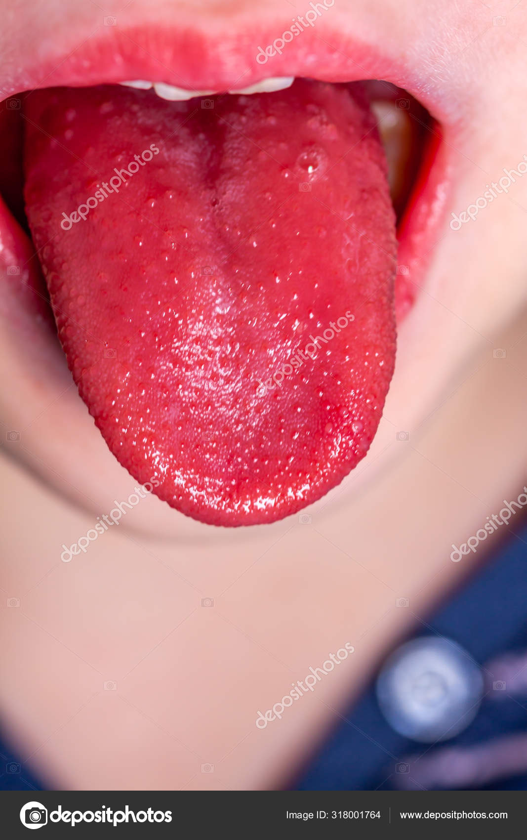 Tongue of a child with scarlet fever strawberry tongue Stock Photo by