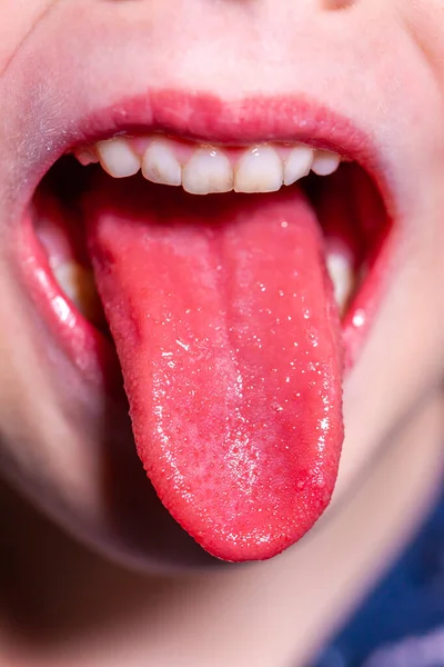 Tongue of a child with scarlet fever - strawberry tongue