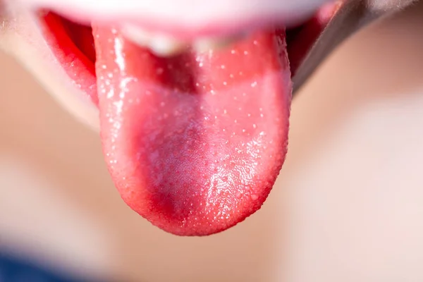 성홍열에 시달리는 어린이의 혀 - 딸기 혀 — 스톡 사진