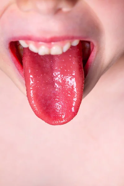 Lengua de un niño con escarlatina - lengua de fresa — Foto de Stock