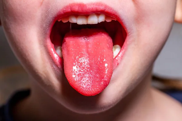 Язик дитини з червоною лихоманкою - полуничний язик — стокове фото