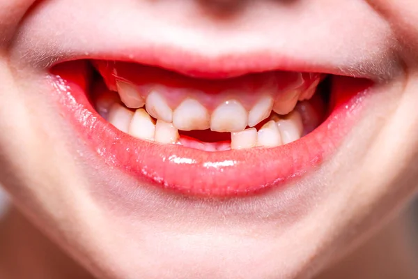 行方不明の歯を持つ少女のクローズ アップ — ストック写真