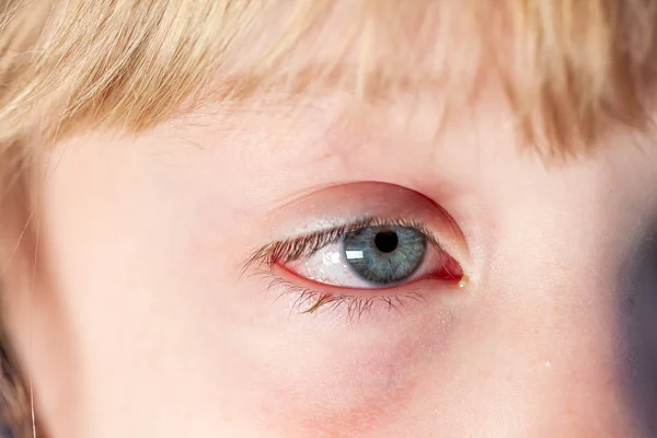 Closeup de olho de sangue vermelho irritado - conjuntivite — Fotografia de Stock