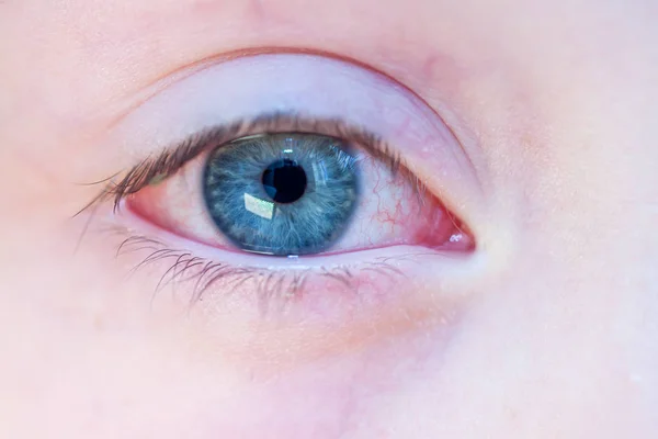 Closeup of irritated red bloodshot eye - conjunctivitis — Stock Photo, Image